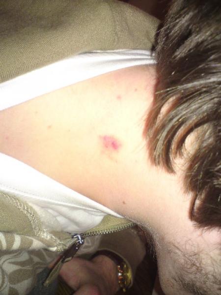 Zoltan's love bite having spent the day with his 15 year old girlfriend ;).